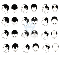 【MG冰球突破官网基因检测】过早<font color='red'>脱发</font>、掉发太多怎么办？你的方法可能是错的！